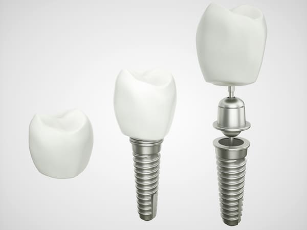 zubni implanti cena