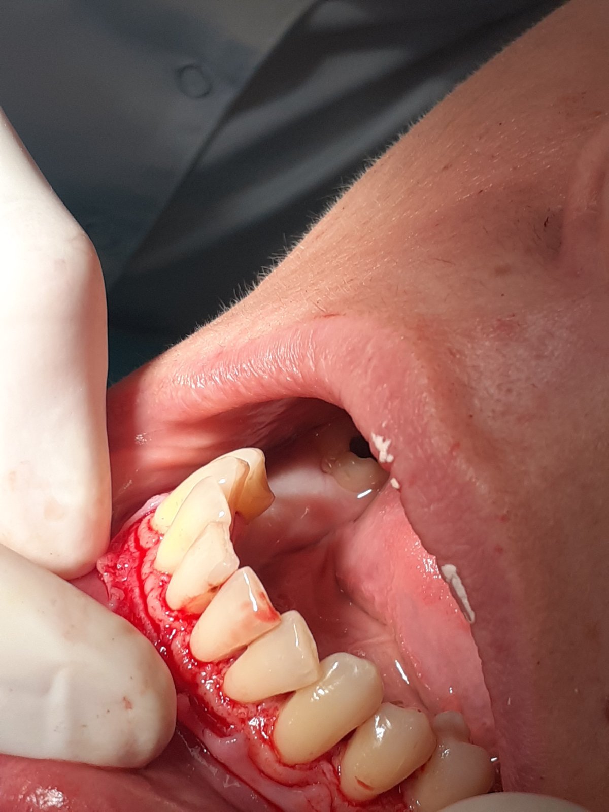 patient no.1: lobe surgery-lifting gums