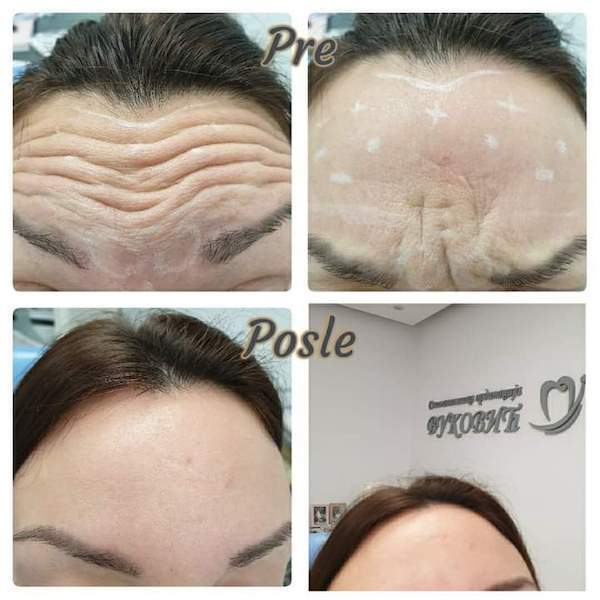 Forehead wrinkles removed only with Botox