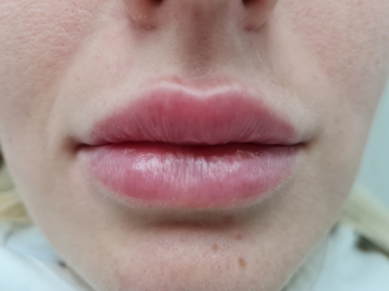 Patient No.2: Before applying the hyaluronic filler to the upper lip