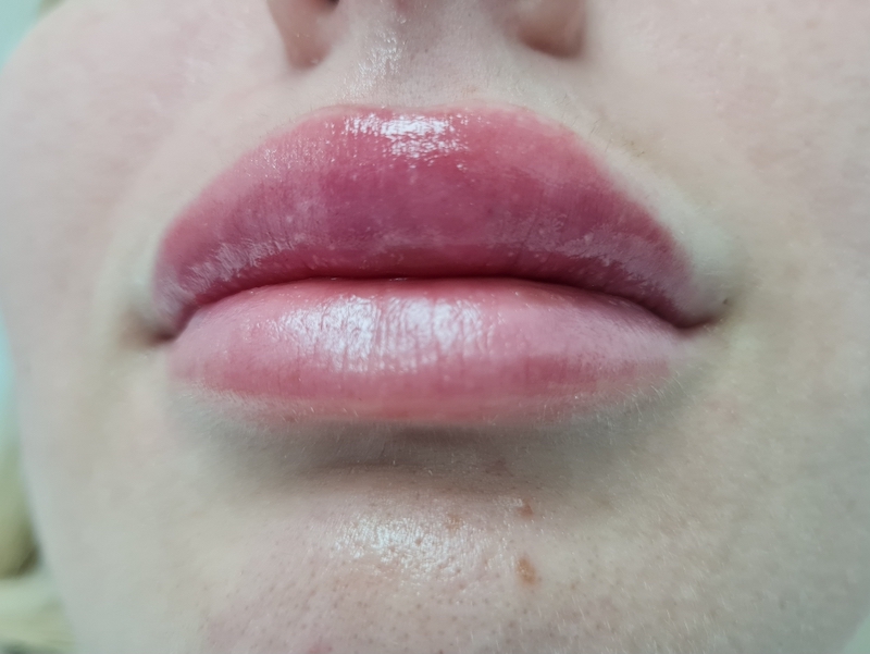 Patient No.2: 1ml of hyaluronic fillers applied only to the upper lip